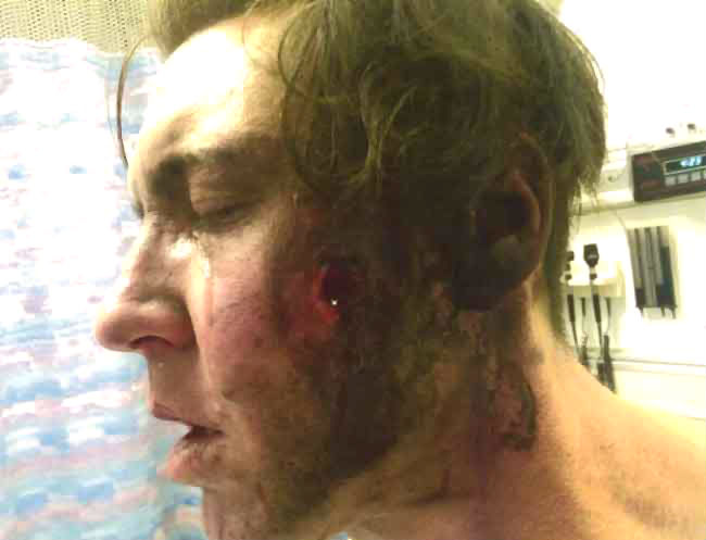 e-cigarette-explosion-face-danny-califf