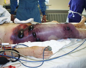 Gas_gangrene